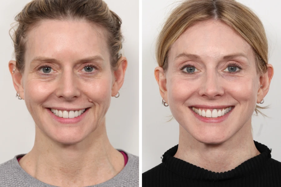 Thread Lift Treatments in Dubai for Non-Surgical Facelifts